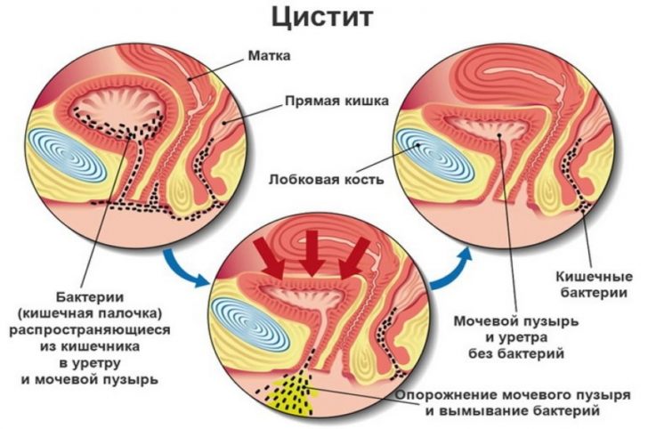 Фуразолідон (таблетки) при циститі – інструкція із застосування, відгуки, аналоги, форма випуску, побічні дії, протипоказання, ціна