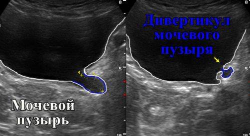 геморагічний Цистит у дитини Біля витоків здоров’я