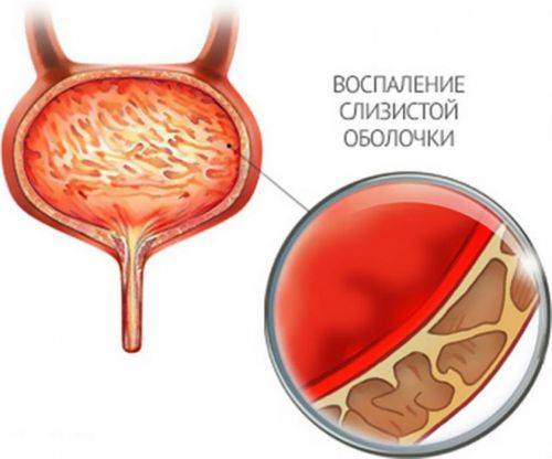 геморагічний Цистит у дитини Біля витоків здоров’я