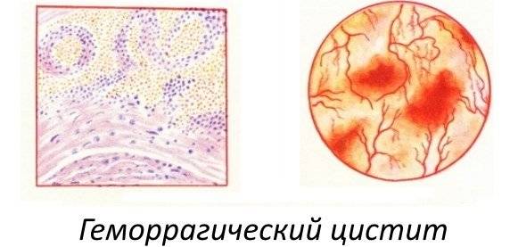 Геморагічний цистит у жінок перші симптоми і методи лікування