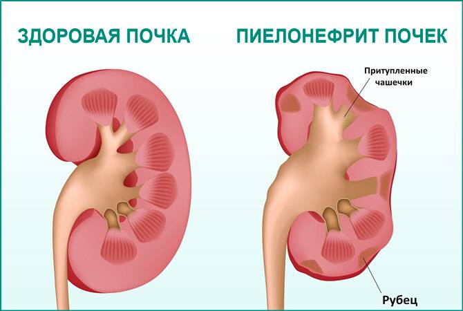 Геморагічний цистит у жінок перші симптоми і методи лікування