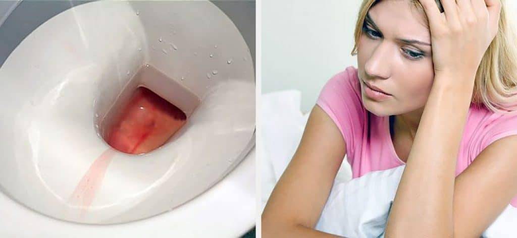 Геморагічний цистит у жінок причини циститу з кров’ю