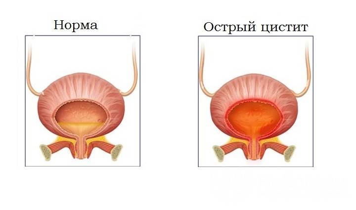 Гострий цистит у жінок та основні ознаки