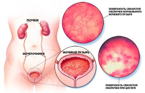 Хронічний цистит: клінічні особливості та лікування. Хронічний цистит у жінок: симптоми та методи лікування
