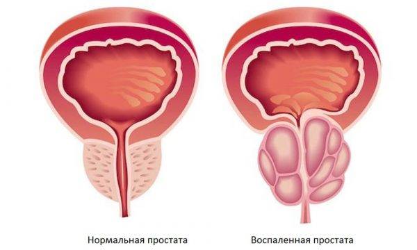 Хронічний цистит у чоловіків симптоми і лікування