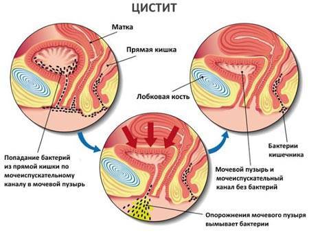 Колір сечі при циститі у жінок