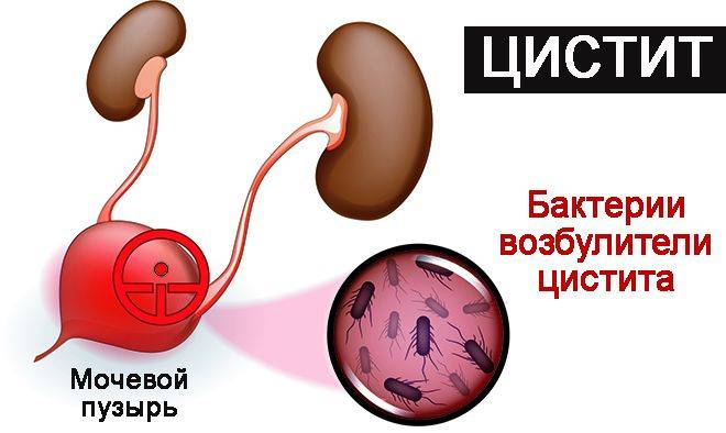 Краплі цистенал при циститі – Лікування циститу