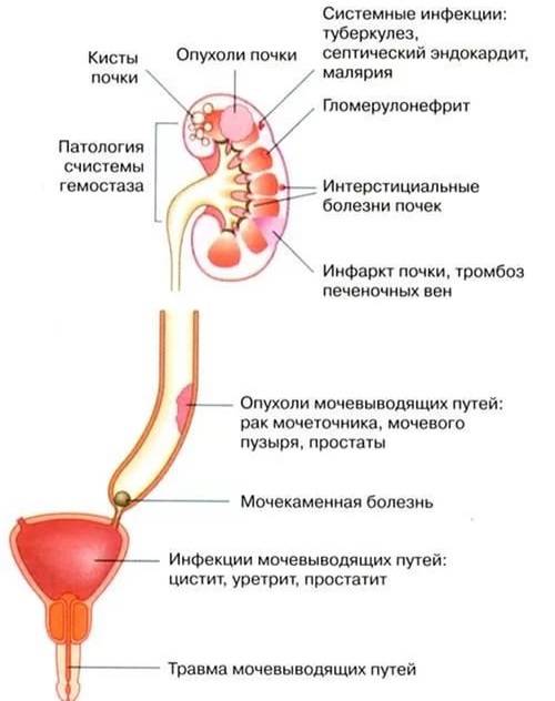 Кров у сечі при циститі у жінок: чому буває, ускладнення, лікування
