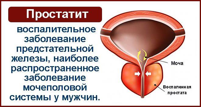 Лікування циститів і сечокам’яної хвороби лікарськими рослинами.