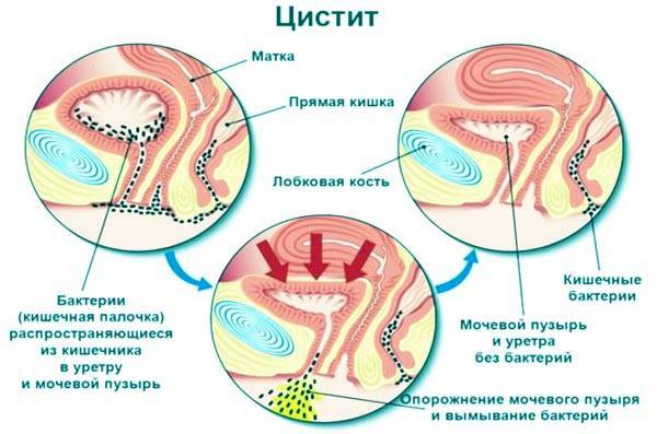 Лікування циститу без антибіотиків