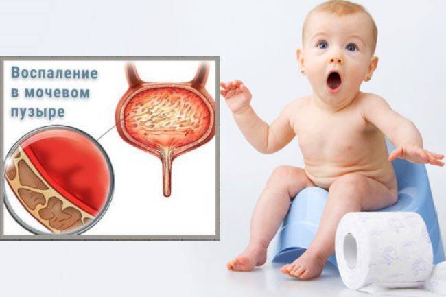 Лікування циститу у дитини 5 років у домашніх умовах
