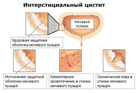 Методи діагностики і лікування інтерстиціального циститу Методи діагностики і лікування інтерстиціального циститу