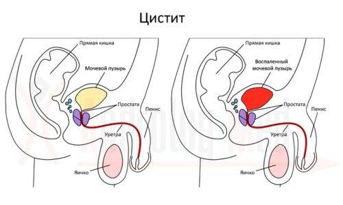 Може цистит пройти сам по собі, без лікування? Може цистит пройти сам по собі, без лікування?