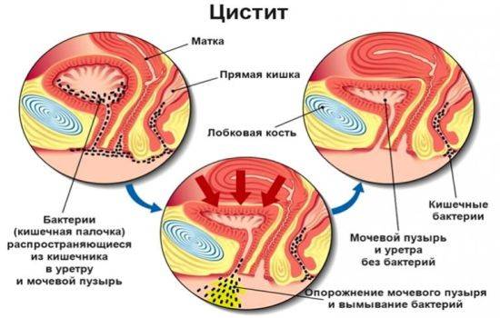Може жінка болеющая циститом заразити чоловіка