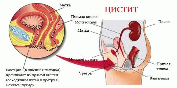 Чи можна алкоголь під час циститу
