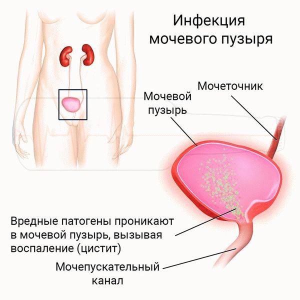 Чи можна алкоголь під час циститу