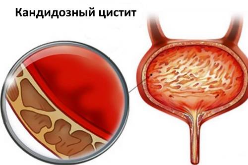 чим лікувати цистит викликаний герпесом