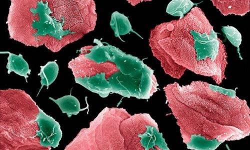 чим лікувати гострий цистит при вагітності на ранніх термінах