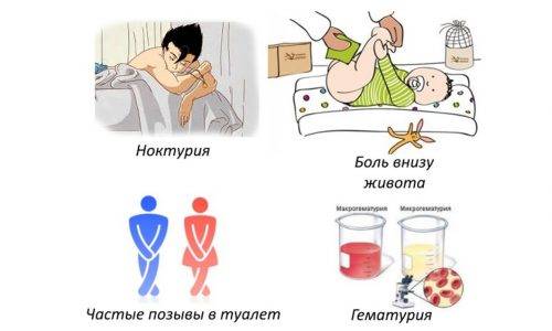 Найбільш ефективні ліки від циститу для дітей