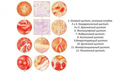 Найбільш ефективні ліки від циститу для дітей