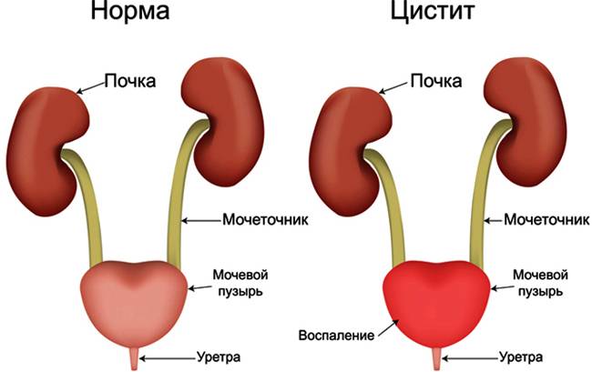 Небактеріальний цистит: види, симптоми і лікування