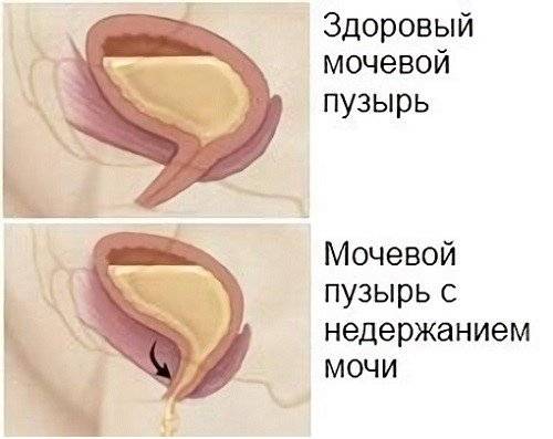 Нетримання сечі при циститі у жінок