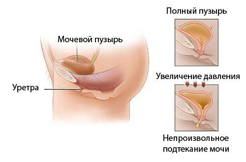Нетримання сечі при циститі у жінок
