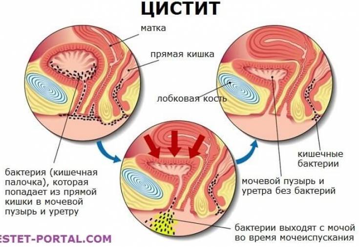 Нетримання сечі при циститі у жінок