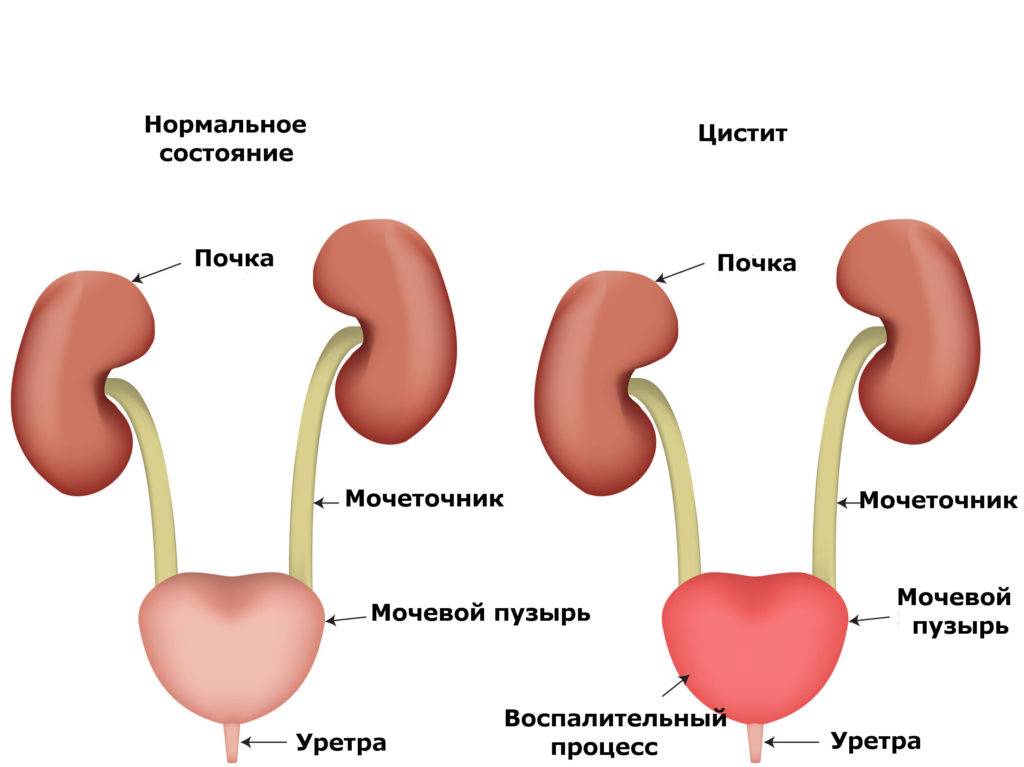 Нетримання сечі при циститі у жінок