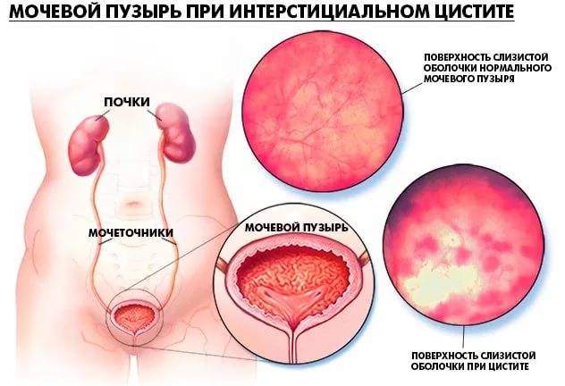 Інфекційний цистит у жінок