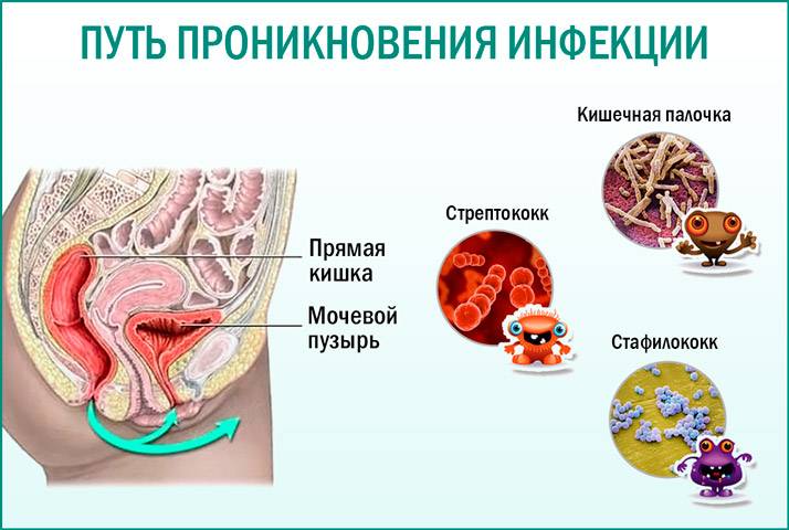 Інфекційний цистит у жінок