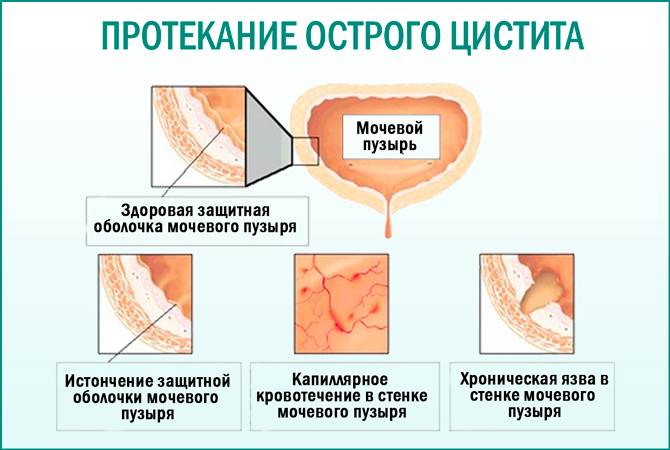 Інструкція по застосуванню Нолицина при циститі