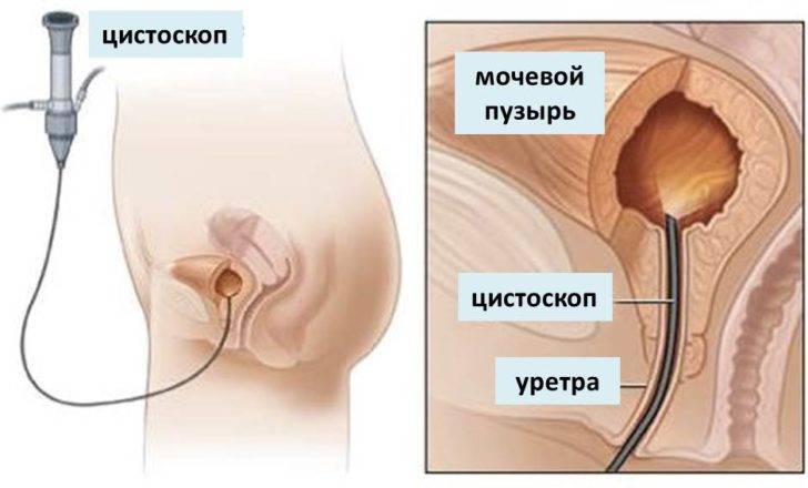 Інтерстиціальний цистит і методи позбавлення від нього – Урогінекологія Інтерстиціальний цистит і методи позбавлення від нього – Урогінекологія