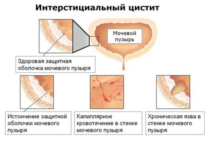Інтерстиціальний цистит і методи позбавлення від нього – Урогінекологія Інтерстиціальний цистит і методи позбавлення від нього – Урогінекологія