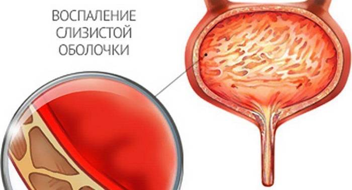 Особливості розвитку та лікування кістозного циститу