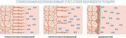 Ознаки і лікування інтерстиціального циститу Ознаки і лікування інтерстиціального циститу