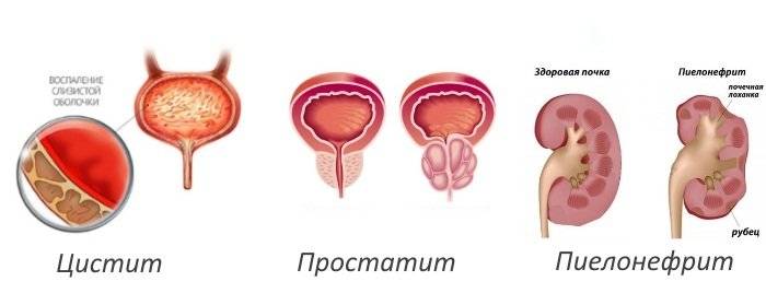 Пієлонефрит і цистит симптоми і лікування