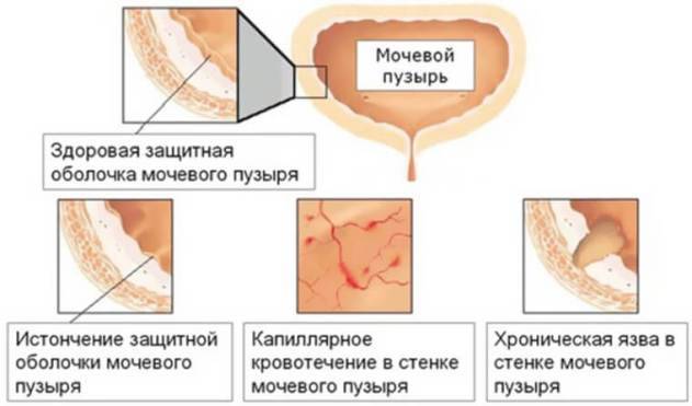 Перші ознаки циститу у чоловіків