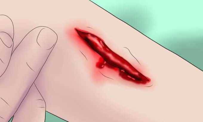 Показання та спосіб застосування Амікацину при циститі