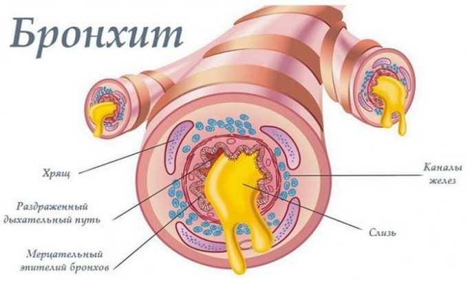 Показання та спосіб застосування Амікацину при циститі