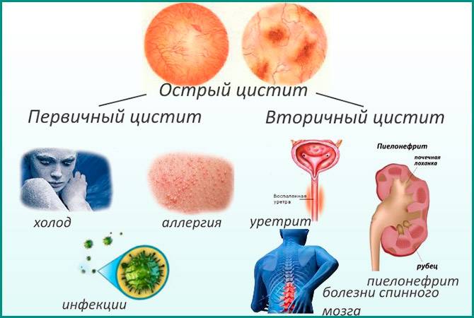Причини циститу на ранніх термінах вагітності