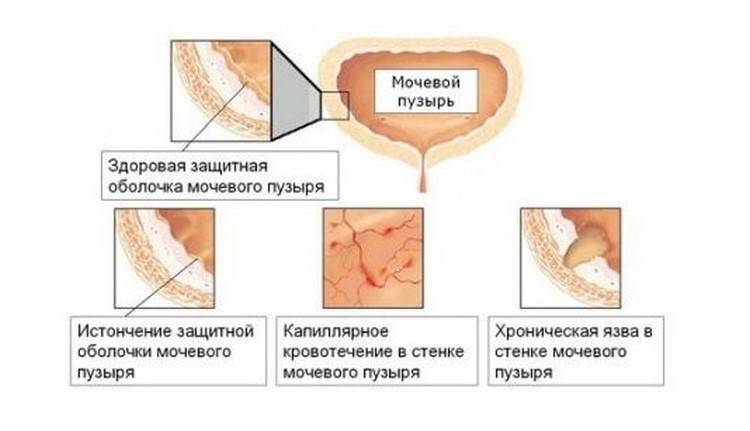 Причини циститу під час менопаузи