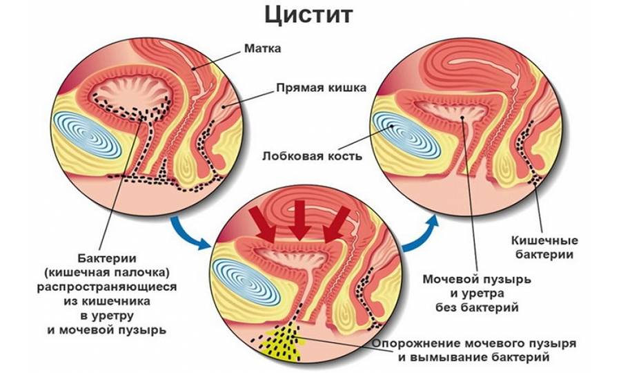 Причини циститу під час менопаузи