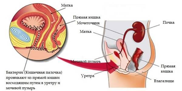 Причини циститу під час менопаузи