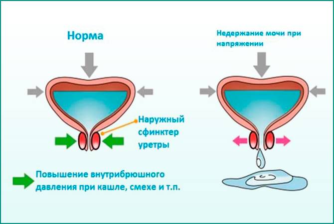 Причини і лікування циститу в літньому віці