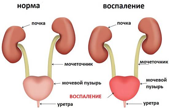 Причини виникнення циститу у жінок – від чого з’являється цистит? Причини виникнення циститу у жінок – від чого з’являється цистит?