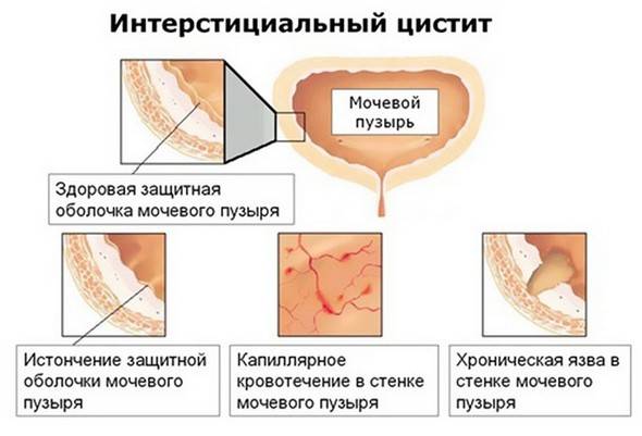 Причини виникнення циститу у жінок – від чого з’являється цистит?