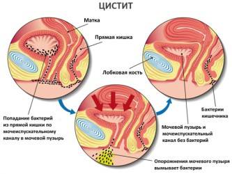 Профілактика посткоитального циститу антибіотиками