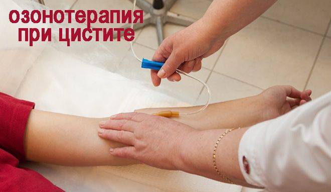 Рецидиви циститу кожен місяць Цистит