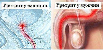 Що приймати при циститі і уретриті